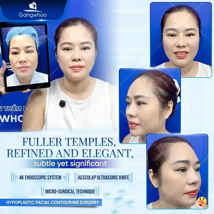 Top 10 Reputable and Safe Temple Augmentation Clinics in Ho Chi Minh City