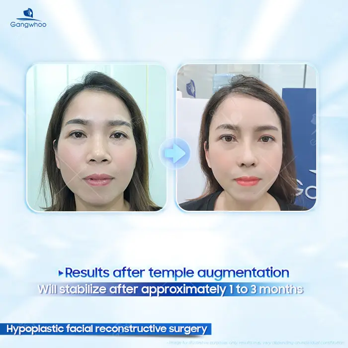 Autologous Fat Temple Augmentation: A Safe and Natural Solution