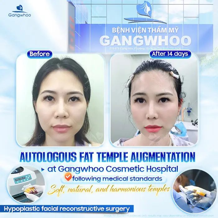 Autologous Fat Temple Augmentation: A Safe and Natural Solution