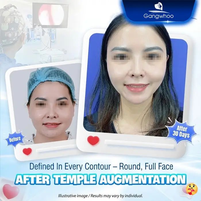 Autologous Fat Temple Augmentation: A Safe and Natural Solution