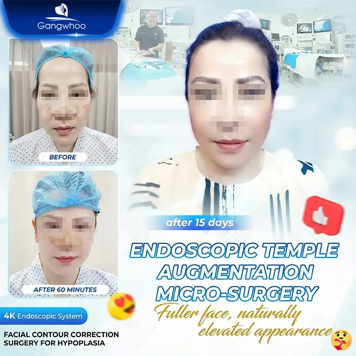 Autologous Fat Temple Augmentation: A Safe and Natural Solution