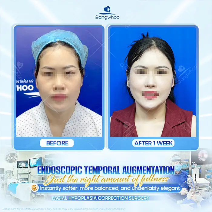 How Long After Temple Augmentation Are Sutures Removed? Post–Suture Removal Care