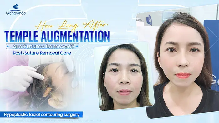 How Long After Temple Augmentation Are Sutures Removed? Post–Suture Removal Care