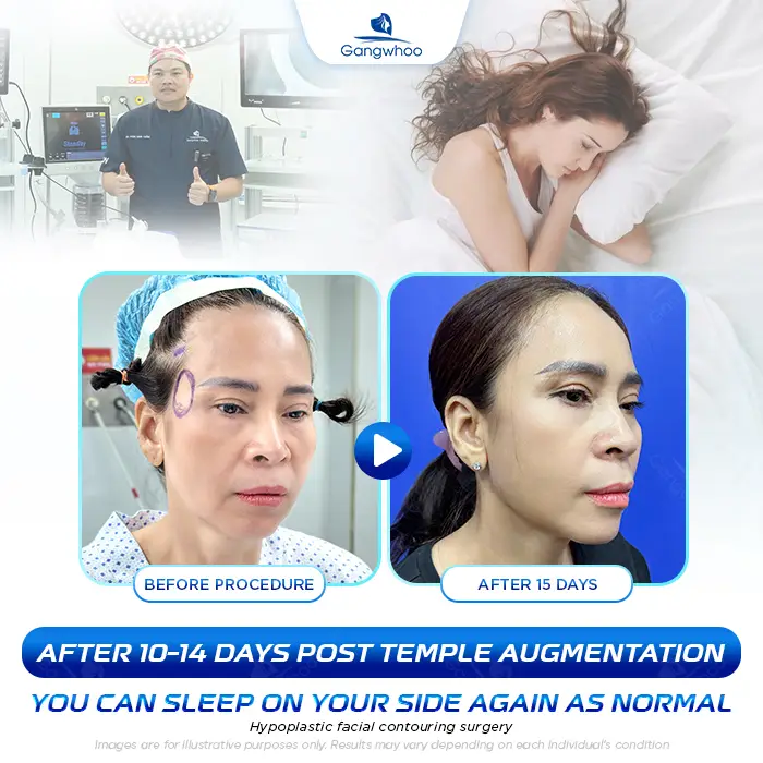 How Long After Temple Augmentation Can You Sleep on Your Side? Doctor’s Explanation