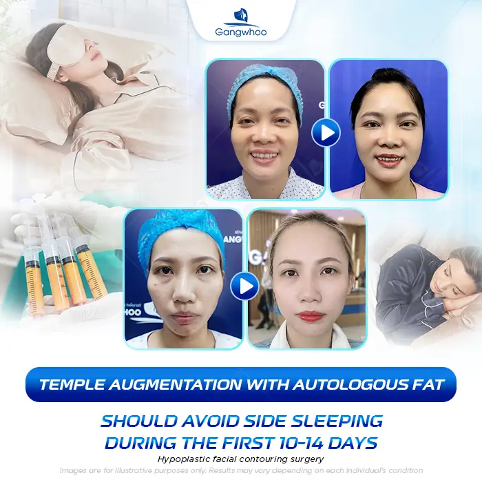How Long After Temple Augmentation Can You Sleep on Your Side? Doctor’s Explanation