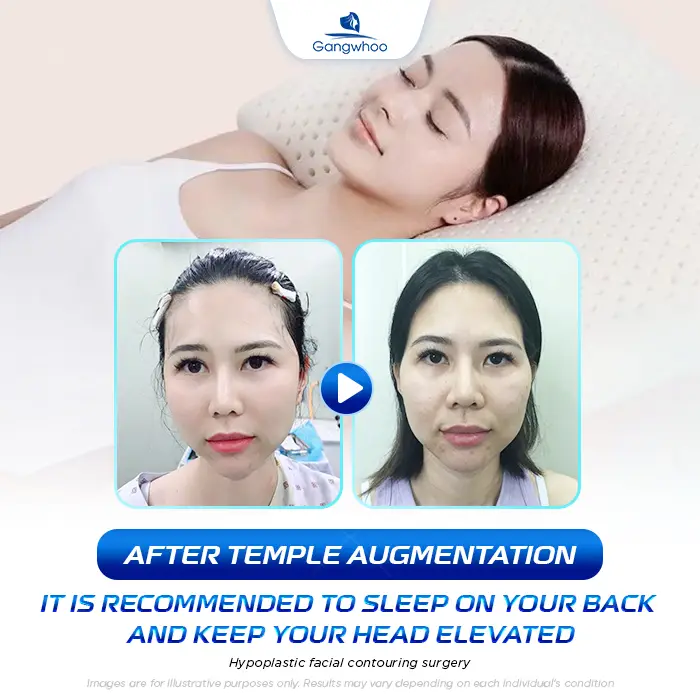 How Long After Temple Augmentation Can You Sleep on Your Side? Doctor’s Explanation