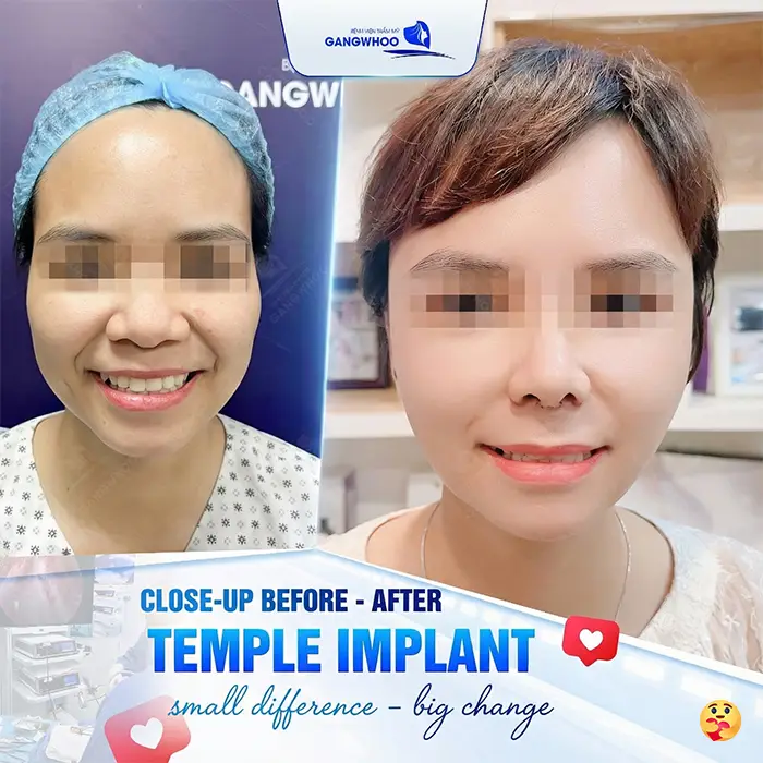 How Long Does Swelling Last After Temple Augmentation? Effective Ways to Reduce Swelling