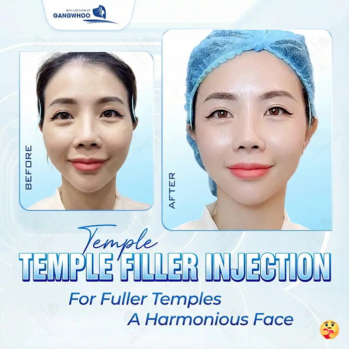How Long Does Swelling Last After Temple Augmentation? Effective Ways to Reduce Swelling