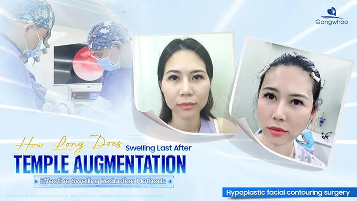How Long Does Swelling Last After Temple Augmentation? Effective Ways to Reduce Swelling