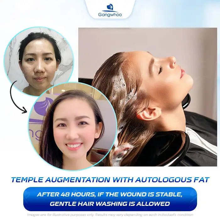 How Long After Temple Augmentation Can You Wash Your Hair? Proper Hair-Washing Guidelines
