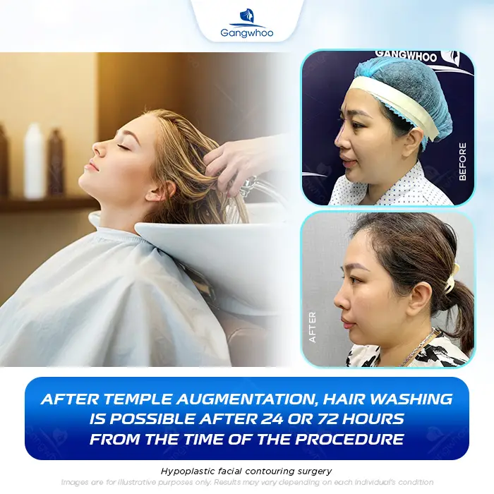How Long After Temple Augmentation Can You Wash Your Hair? Proper Hair-Washing Guidelines