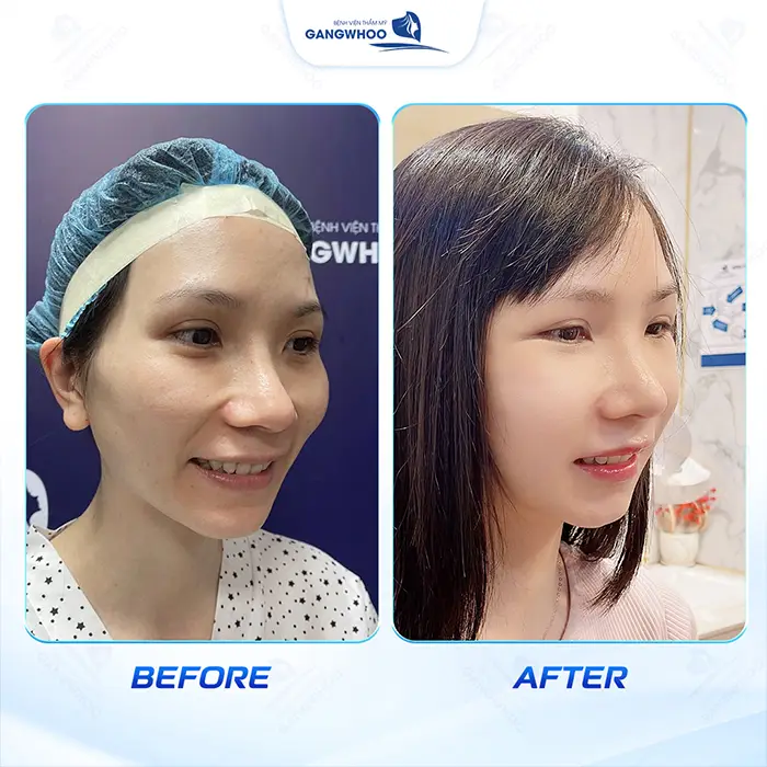 How Long Does It Take for Temple Augmentation to Heal? Recovery Stages Explained