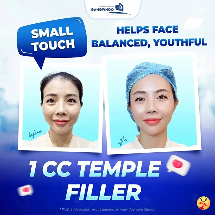 How Long Does It Take for Temple Augmentation to Heal? Recovery Stages Explained