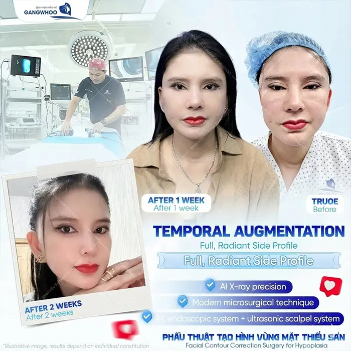 How Long Does It Take for Temple Augmentation to Heal? Recovery Stages Explained