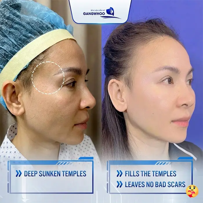 How Long Does It Take for Temple Augmentation to Heal? Recovery Stages Explained