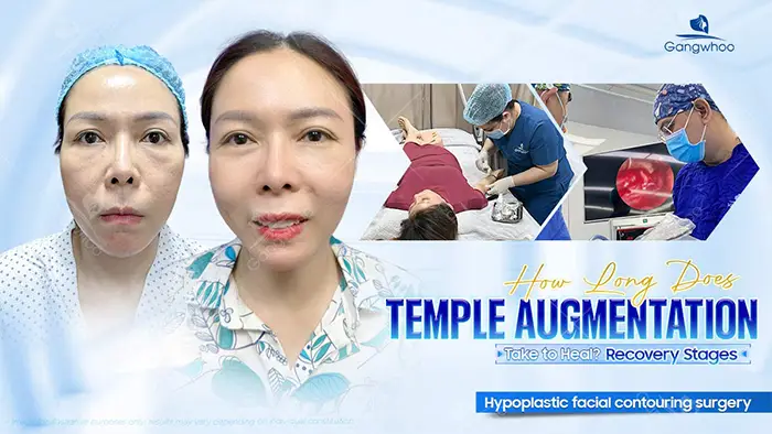 How Long Does It Take for Temple Augmentation to Heal? Recovery Stages Explained