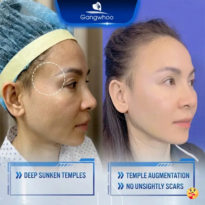 Will Temple Augmentation Be Visible? Causes and Treatment Options
