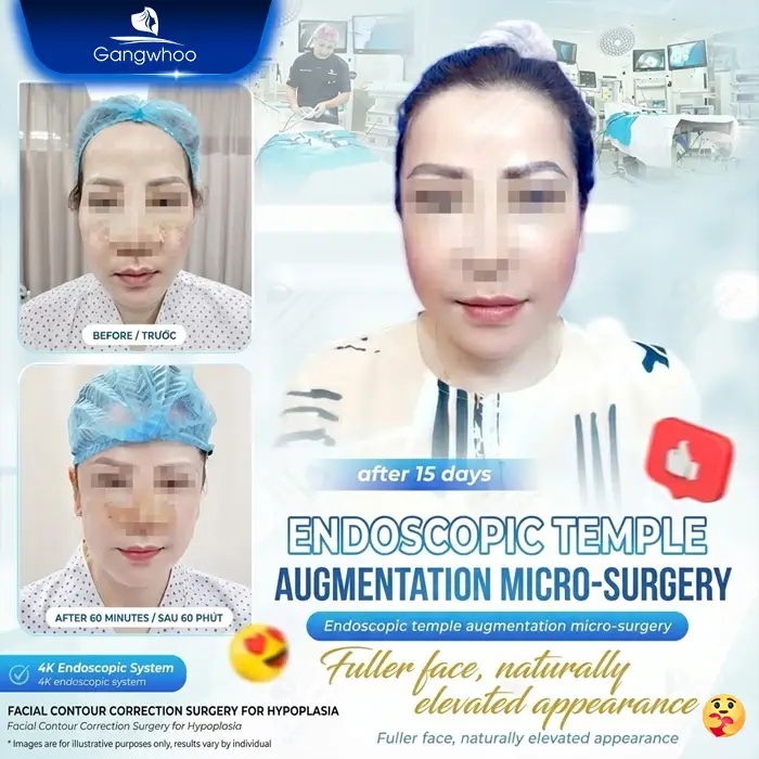 Will Temple Augmentation Be Visible? Causes and Treatment Options