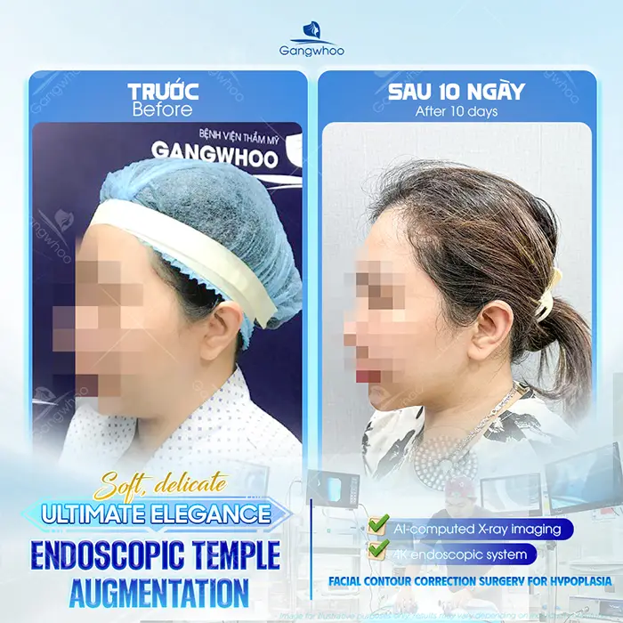 Will Temple Augmentation Be Visible? Causes and Treatment Options