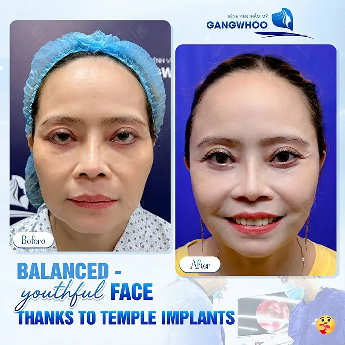 How Long Does Temple Augmentation Last? Proper Aftercare Guidelines