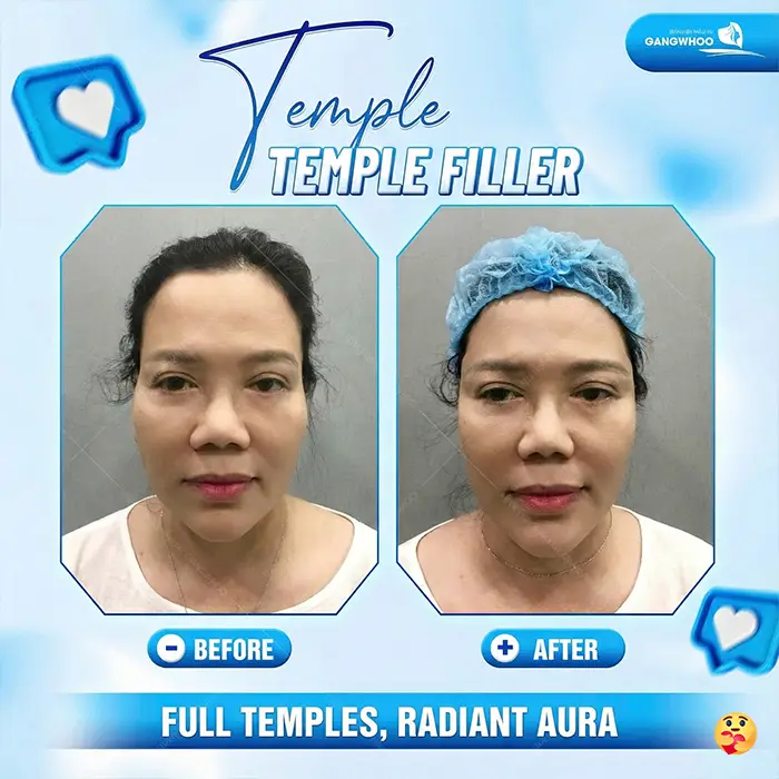 How Long Does Temple Augmentation Last? Proper Aftercare Guidelines