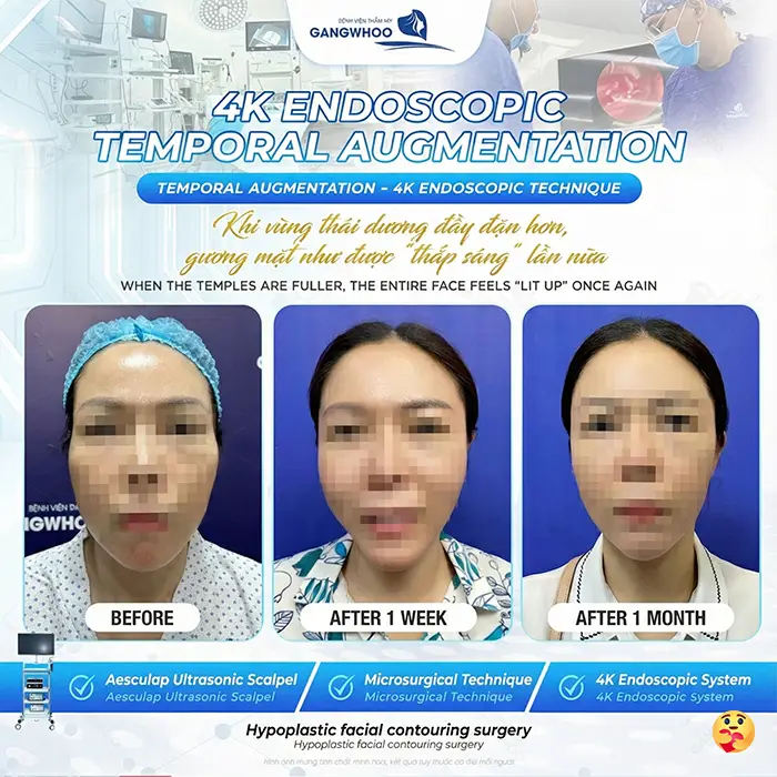 How Long Does Temple Augmentation Last? Proper Aftercare Guidelines