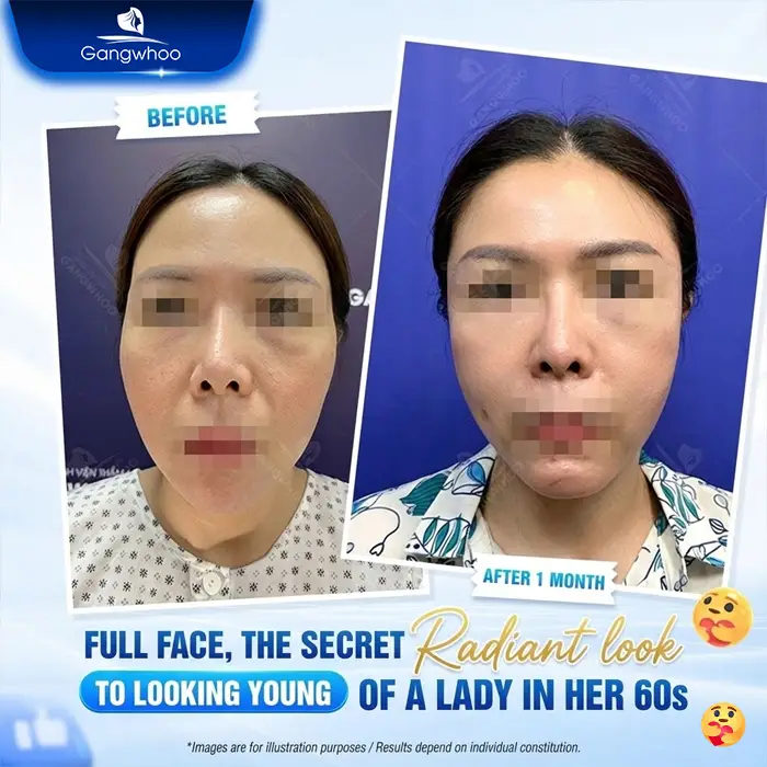 Can You Get Filler Injections After Temple Augmentation? Expert Answers from a Specialist
