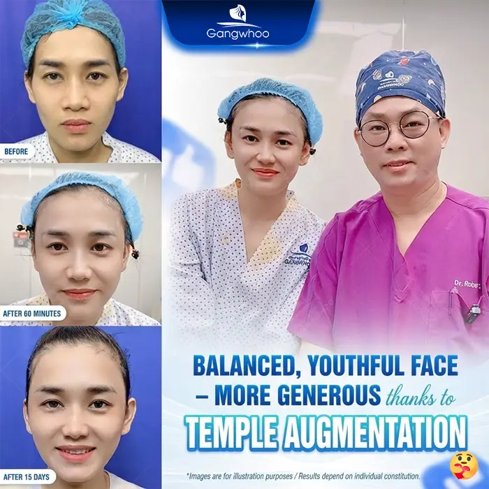 Can You Get Filler Injections After Temple Augmentation? Expert Answers from a Specialist