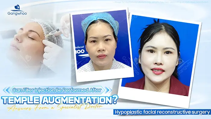 Can You Get Filler Injections After Temple Augmentation? Expert Answers from a Specialist