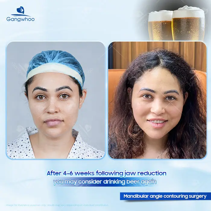 How Long After Jaw Reduction Surgery Can You Drink Beer? A Doctor Explains