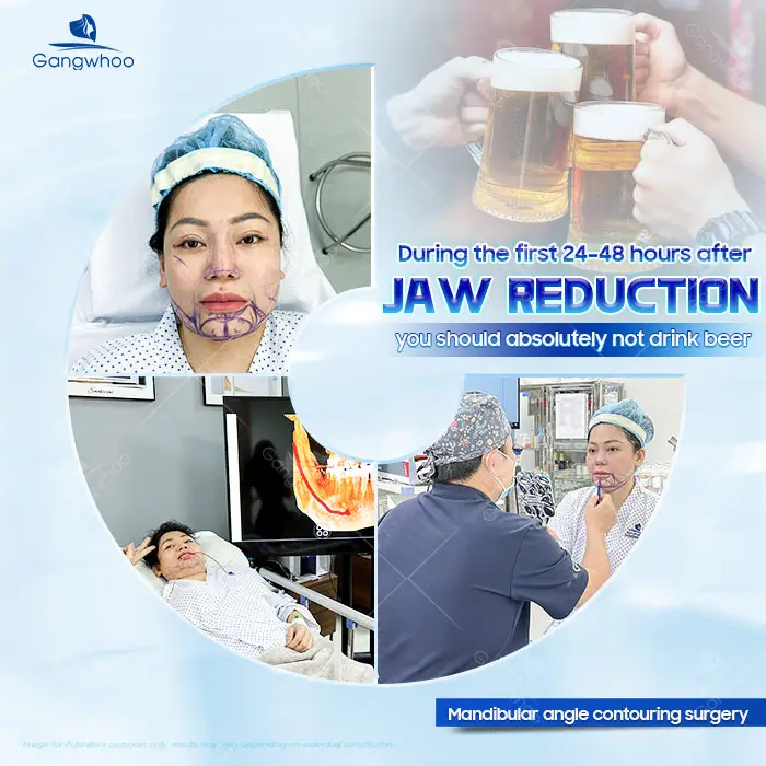 How Long After Jaw Reduction Surgery Can You Drink Beer? A Doctor Explains