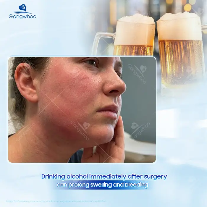How Long After Jaw Reduction Surgery Can You Drink Beer? A Doctor Explains