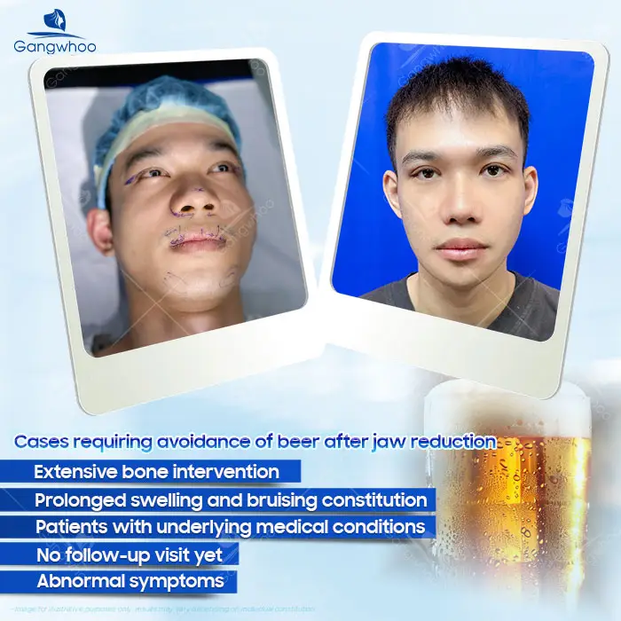 How Long After Jaw Reduction Surgery Can You Drink Beer? A Doctor Explains