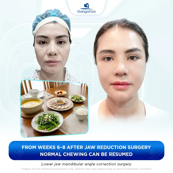 How Long After Jaw Shaving Can You Eat? A Safe Post-Surgery Eating Timeline