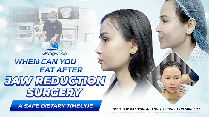 How Long After Jaw Shaving Can You Eat? A Safe Post-Surgery Eating Timeline