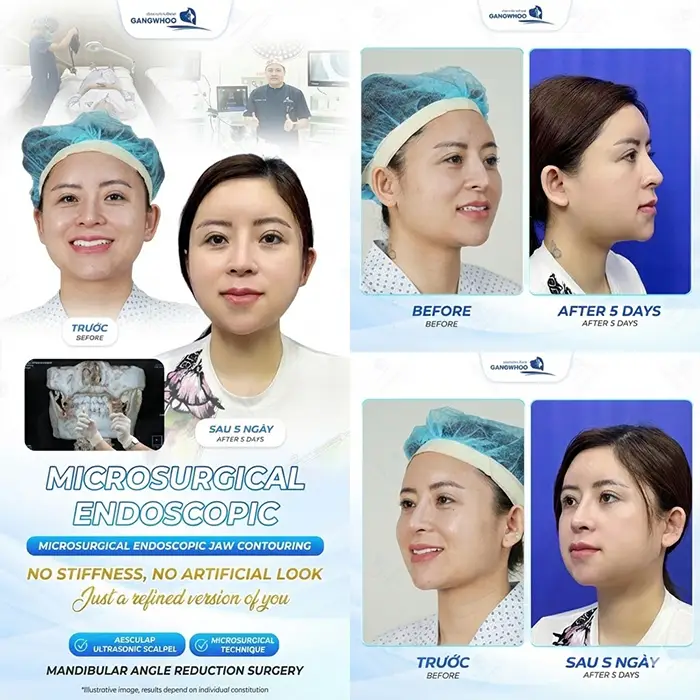 How Long Should You Wear a Compression Garment After Jaw Reduction Surgery? Proper Wearing Guidelines