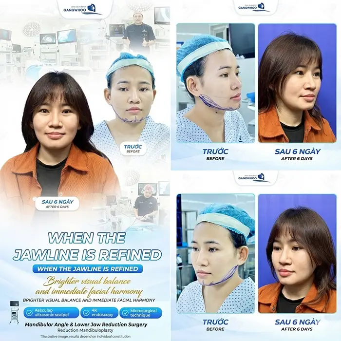 How Long Should You Wear a Compression Garment After Jaw Reduction Surgery? Proper Wearing Guidelines