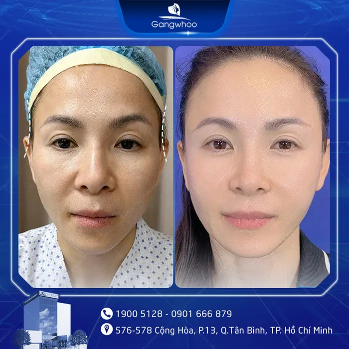 How Long Does It Take for Temple Augmentation to Heal? Recovery Stages Explained