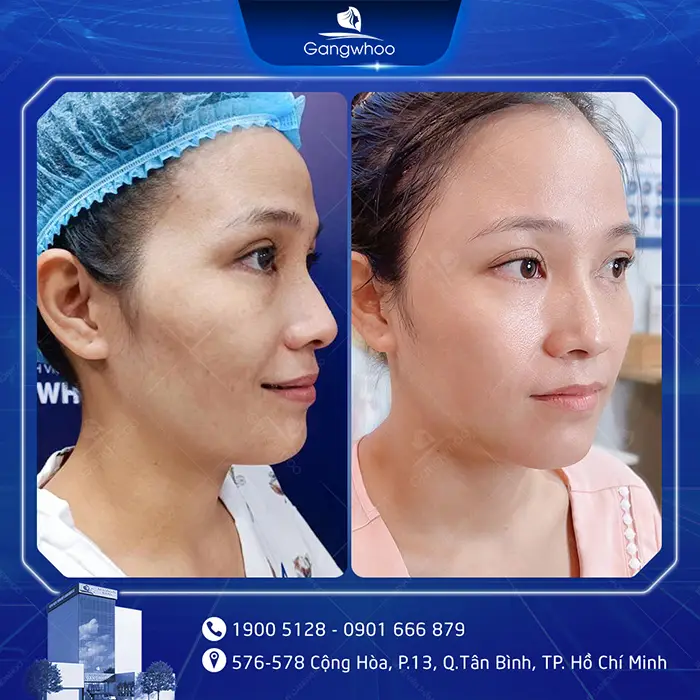 How Long Does It Take for Temple Augmentation to Heal? Recovery Stages Explained