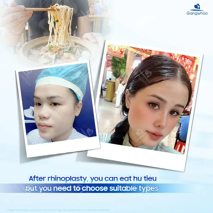 Can You Eat Hu Tieu After Rhinoplasty? A Doctor’s Detailed Explanation