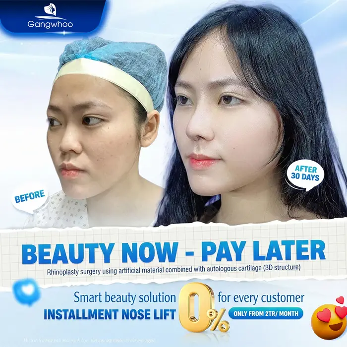 0% Installment Rhinoplasty – Achieve a Beautiful Nose Without Financial Pressure