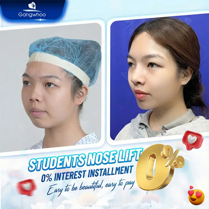 0% Installment Rhinoplasty – Achieve a Beautiful Nose Without Financial Pressure
