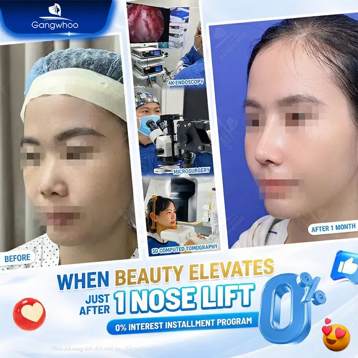 0% Installment Rhinoplasty – Achieve a Beautiful Nose Without Financial Pressure