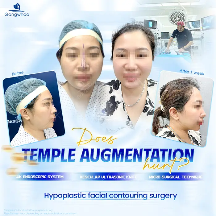 Should You Get Temple Implants, Filler Injections, or Fat Grafting? – Doctor’s Explanation