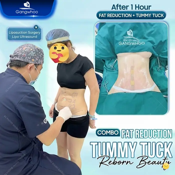 Postpartum Abdominoplasty: Procedure and Costs