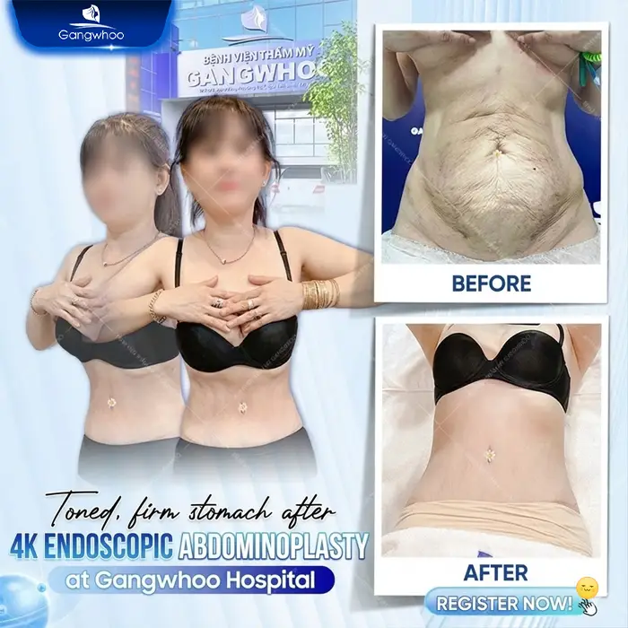 Postpartum Abdominoplasty: Procedure and Costs