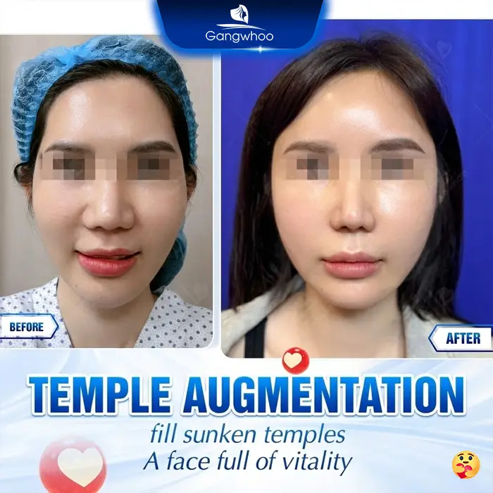 Temple Augmentation Materials: 3 Commonly Used Options