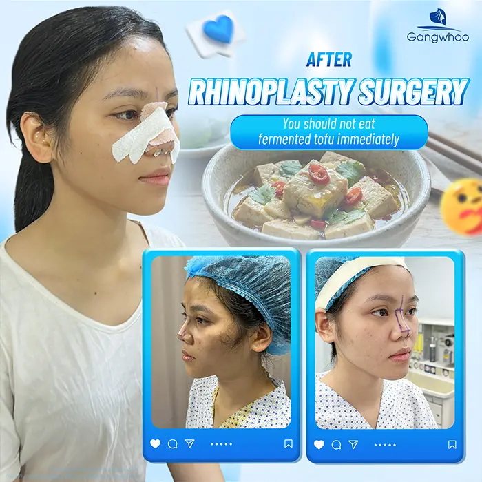 Can You Eat Fermented Tofu (Chao) After Rhinoplasty? How Long Should You Avoid It?