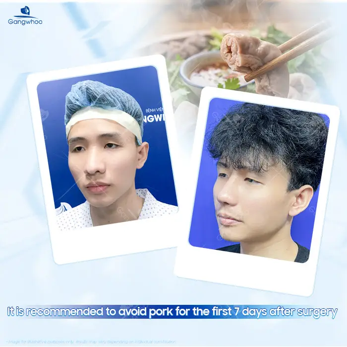 Can You Eat Pork Intestines After Rhinoplasty? A Doctor’s Detailed Explanation