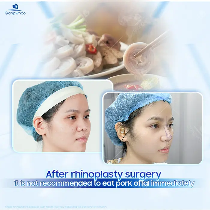 Can You Eat Pork Intestines After Rhinoplasty? A Doctor’s Detailed Explanation
